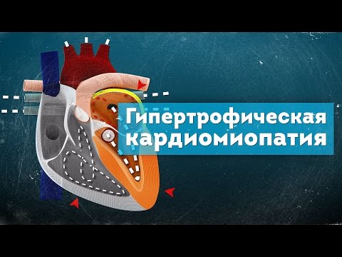 Видео: Гипертрофическая кардиомиопатия. Патогенез. Hypertrophic Cardiomyopathy 3D