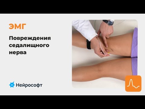 Видео: ЭМГ: Диагностика Повреждений Седалищного Нерва