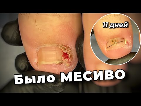 Видео: Сказали пусть заживет потом будем решать что делать с этим….