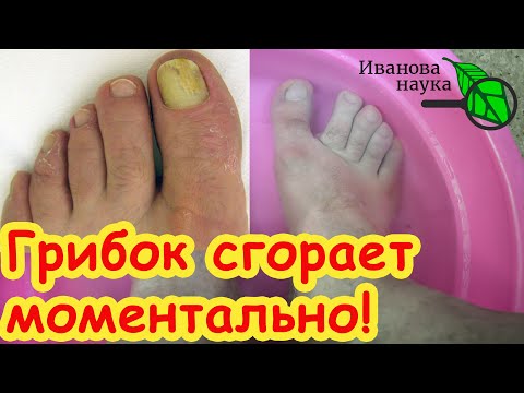 Видео: БЕЗ ТАБЛЕТОК, МАЗЕЙ и ПОБОЧКИ: природное лечение грибка ногтей и кожи. Лучшее средство от грибка.