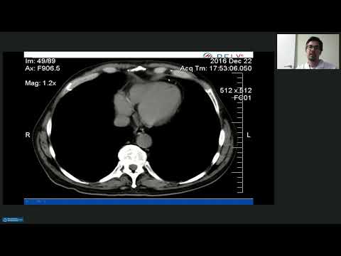 Видео: Возможности ультразвукового исследования эпикардиальной жировой ткани у пациентов с ИБС