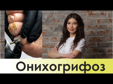 Видео: Аппаратный педикюр, утолщенный ноготь. Онихогрифоз. Трансляция из Instagram