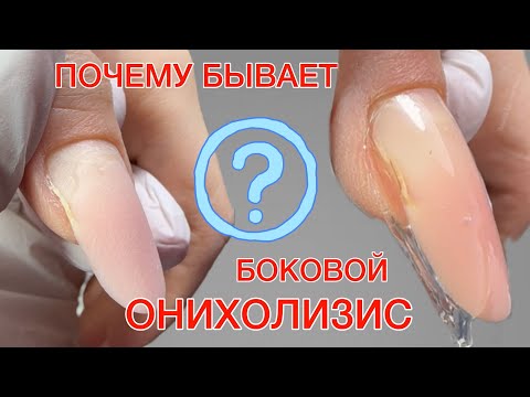 Видео: БОКОВОЙ ОНИХОЛИЗИС | КОРРЕКЦИЯ ГЕЛЕМ | ВЕРХНИЕ ФОРМЫ #алена_лаврентьева #nails #ногти #маникюр