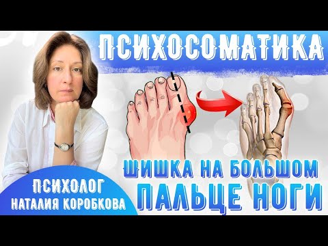 Видео: Шишка на большом пальце ноги Психосоматика