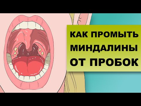 Видео: КАК ПРОМЫТЬ МИНДАЛИНЫ ОТ ПРОБОК
