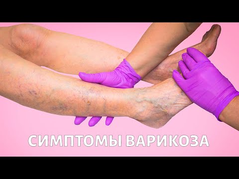 Видео: Варикозная болезнь нижних конечностей: признаки и диагностика