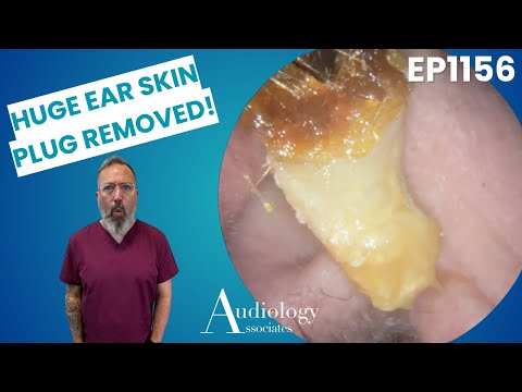 Видео: Две истории об удалении кожи с дикого уха, которые вам стоит увидеть! - EP1156
