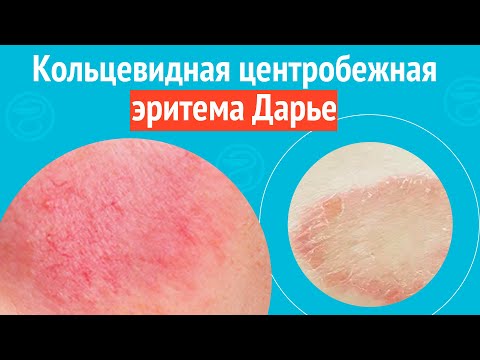 Видео: 💍 Кольцевидная центробежная эритема Дарье. Клинический случай №1581