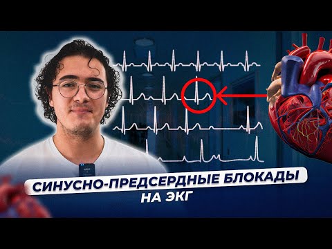 Видео: Синусно-предсердные блокады на ЭКГ (CА-блокады)