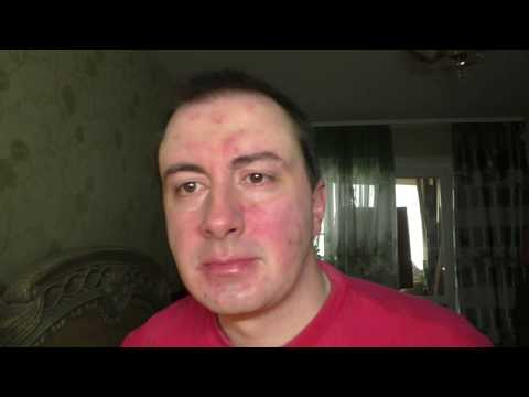 Видео: История о том как я лечил розацеа