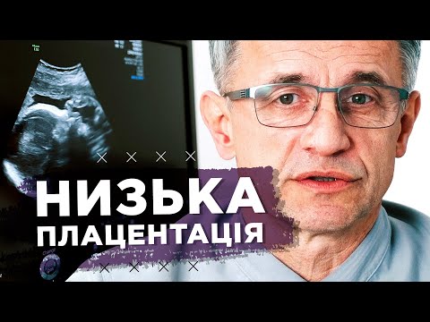 Видео: Низька плацентація при вагітності: симптоми, чим загрожує і як лікувати