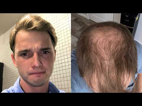 Видео: ЛЫСЕНИЕ В 20+ — пора побрить голову налысо
