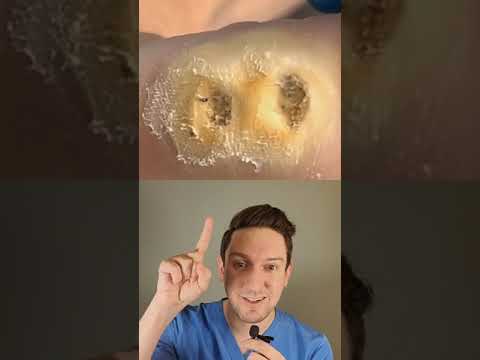 Видео: ДЕРМАТОЛОГ объясняет, как удалять и лечить бородавки на СТОПЕ