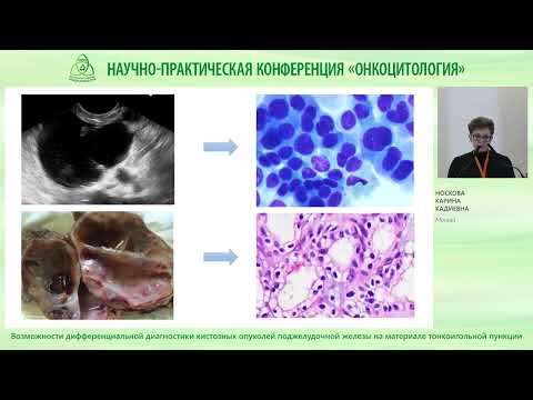 Видео: Возможности дифференциальной диагностики кистозных опухолей поджелудочной железы