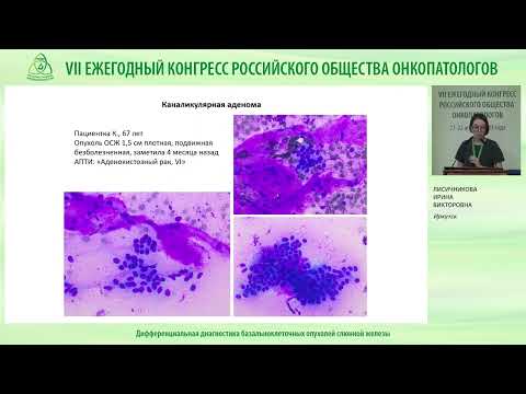 Видео: Дифференциальная диагностика базальноклеточных опухолей слюнной железы