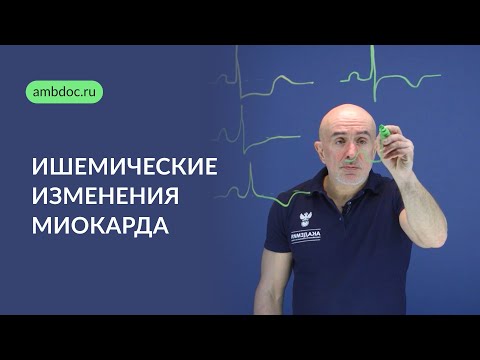 Видео: Ишемические изменения миокарда на ЭКГ