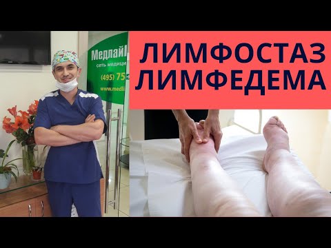 Видео: Лимфатический отек. Лимфостаз. Лимфедема. Флеболог Москва.