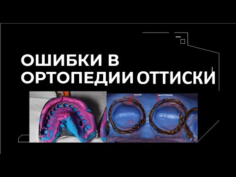 Видео: ОШИБКИ В ОРТОПЕДИИ  ОТТИСК часть 3