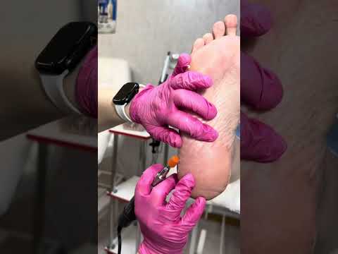 Видео: Препаратный педикюр #педикюр # фруктовый педикюр # Подолог #подология 