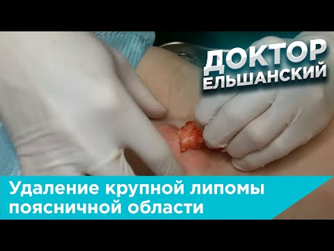 Видео: Удаление крупной липомы поясничной области при липоматозе