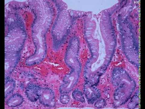 Видео: Зальцбуржские семинары  Гистология ГЭРБ и пищевода Барретта