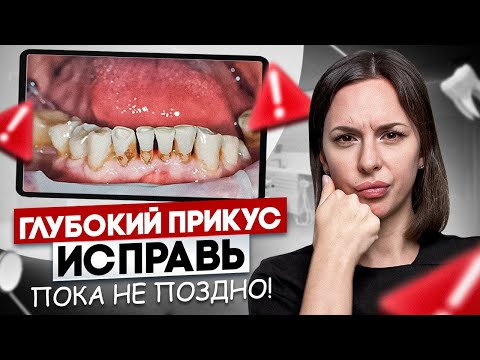 Видео: Глубокий Прикус ДО и ПОСЛЕ | Исправление глубокого прикуса ПОЧЕМУ ЭТО ВАЖНО?!