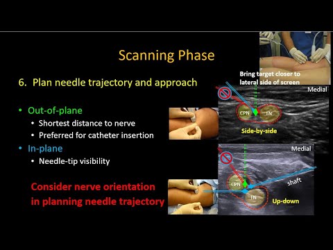 Видео: Блокада подколенного седалищного нерва под контролем УЗИ