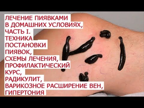 Видео: Лечение пиявками в домашних условиях, часть I  Техника постановки пиявок, схемы лечения