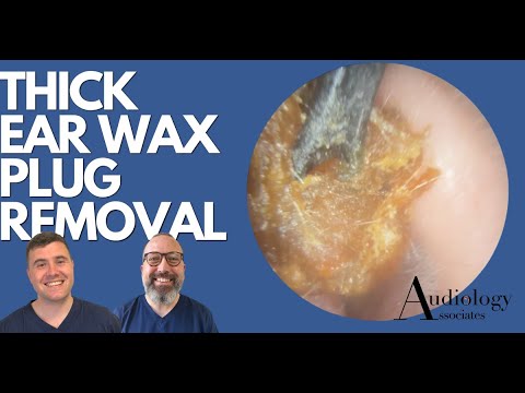 Видео: УДАЛЕНИЕ ТОЛСТОЙ, ЛИПКОЙ СЕРНОЙ ПРОБКИ В УШАХ - EP882