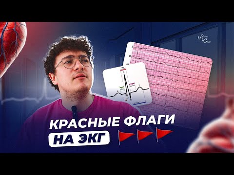 Видео: Красные флаги на ЭКГ. Что нельзя пропустить?