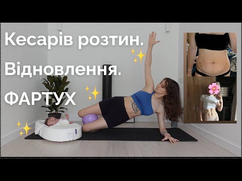 Видео: ФАРТУХ. Шрам після кесаревого. Як відновитись після КР