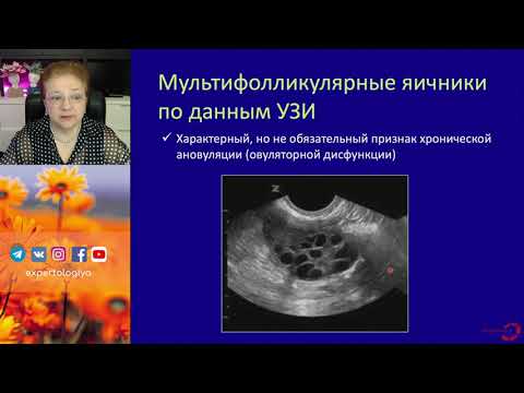 Видео: Экспертология l Хроническая ановуляция