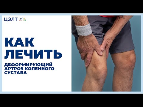 Видео: 🚶 Как лечить деформирующий артроз коленного сустава. Деформирующий артроз коленного сустава. 12+
