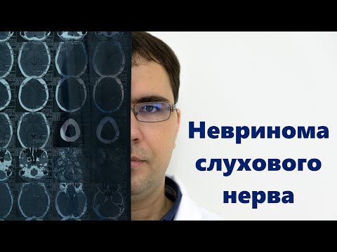 Видео: Невринома слухового нерва: симптомы, диагностика, лечение