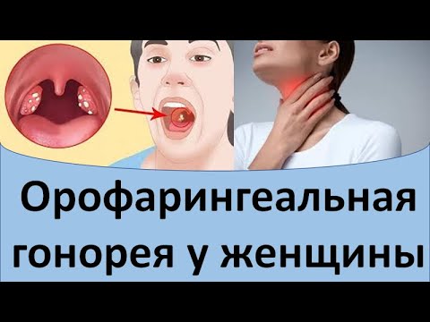 Видео: Орофарингеальная гонорея у женщины