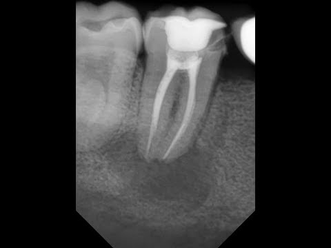Видео: Когда нужно обтурировать каналы для лечения периодонтита?