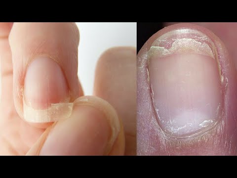 Видео: Что делать если слоятся ногти? ✅8 способов лечения ногтей в домашних условиях / Как УКРЕПИТЬ НОГТИ