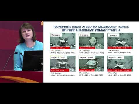 Видео: «Сложный пациент с акромегалией: тактика ведения». Иловайская И.А.