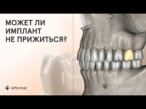 Видео: 🔎 Тест на отторжение имплантов: может ли имплант не прижиться? И что дает гарантия на импланты?