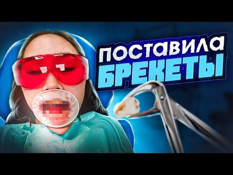 Видео: БРЕКЕТЫ: ЦЕНА, БОЛЬ, ЗАПРЕТЫ | ГДЕ НЕЛЬЗЯ ЛЕЧИТЬ ЗУБЫ? | ИМПЛАНТ ЛАБ в МОСКВЕ и МОЙ ЛИЧНЫЙ ОПЫТ 2024