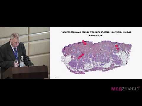 Видео: 7. Прощай, гемангиома!