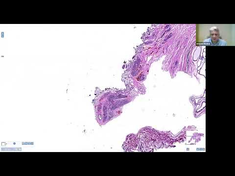 Видео: 1. Инвазивная неспецифическая карцинома молочной железы