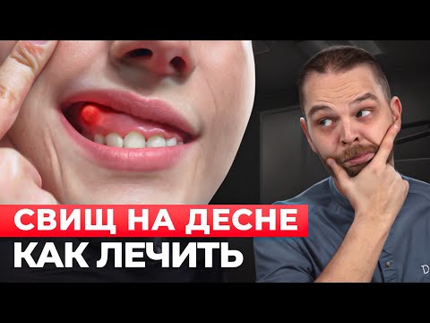 Видео: Свищ на десне? Спасай зуб!