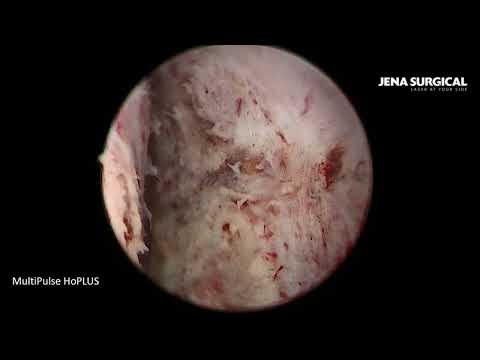 Видео: Лазерная энуклеация аденомы простаты 80 см3 en-block. Гольмиевый лазер MultiPulse HoPlus.