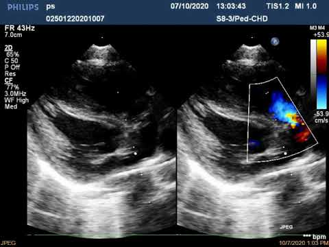 Видео: Эхо КГ с анализом стеноза легочной артерии (рус. перевод)