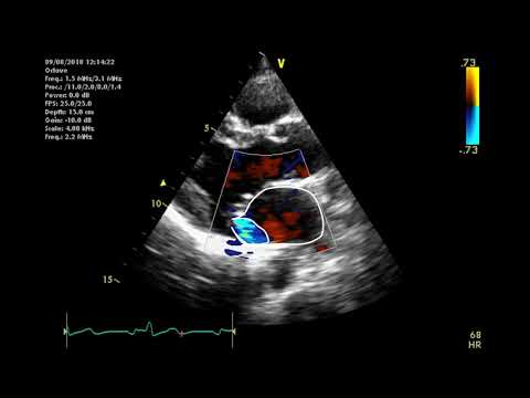 Видео: Эхокардиографическая оценка митрального клапана