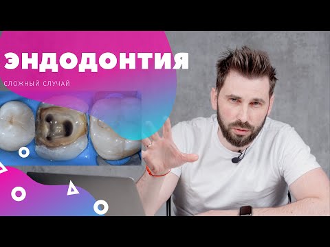 Видео: Эндодонтия. Новый сложный случай из практики