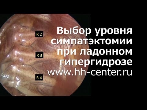 Видео: Выбор уровня проведения симпатэктомии