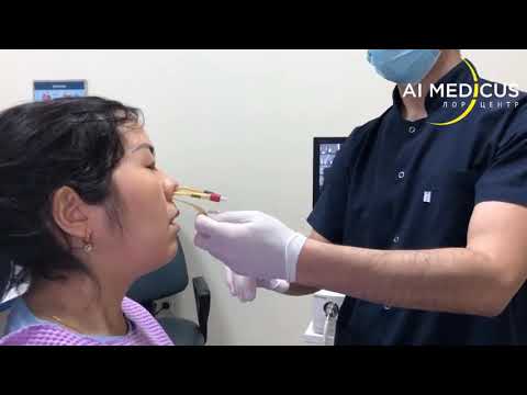 Видео: Лечение гайморита без прокола в Алматы (лечение гайморита ЯМИК катетером). ЛОР Центр "Ай-Медикус"