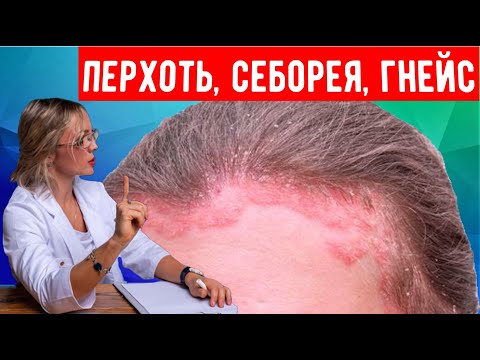 Видео: Себорейный дерматит на голове, лице и теле.